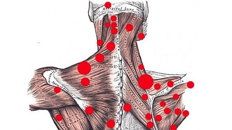 Spúšťacie body vo svaloch, ktoré vyvolávajú myofasciálne bolesti chrbta