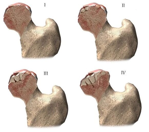 štádia artrózy bedrového kĺbu