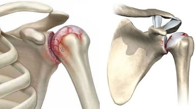 poranenie ramenného kĺbu v dôsledku artrózy