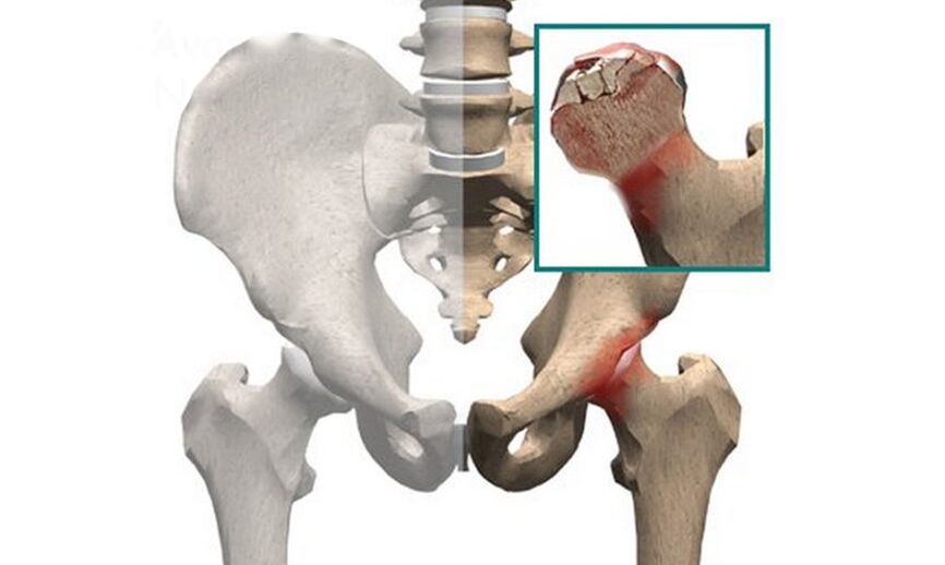 Nekróza hlavice stehennej kosti je jednou z príčin bolesti v bedrovom kĺbe