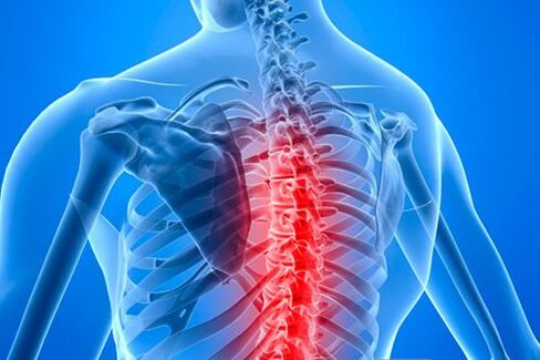 Hrudná chrbtica s príznakmi osteochondrózy