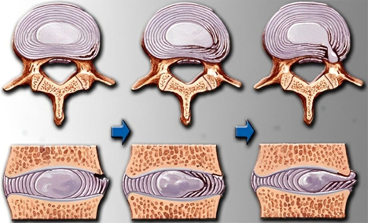 štádia osteochondrózy