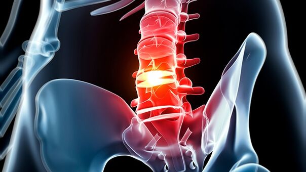 osteochondróza bedrovej chrbtice