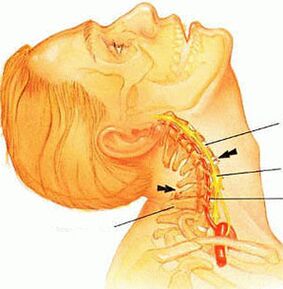 Osteochondróza krčnej chrbtice